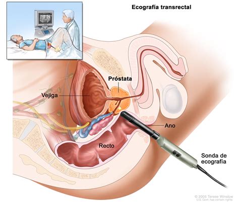 Tratamiento Del Cáncer De Próstata Pdq® Versión Para