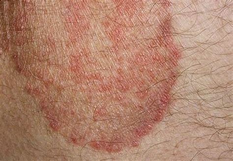 itchy skin patches corplidiy