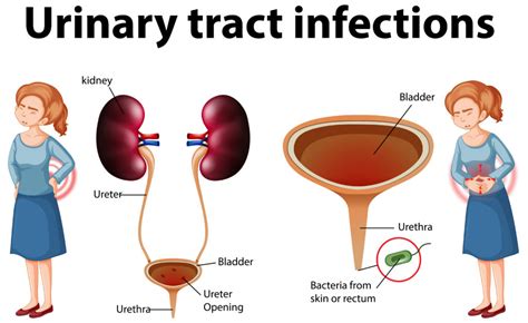 urinary tract infection discharge