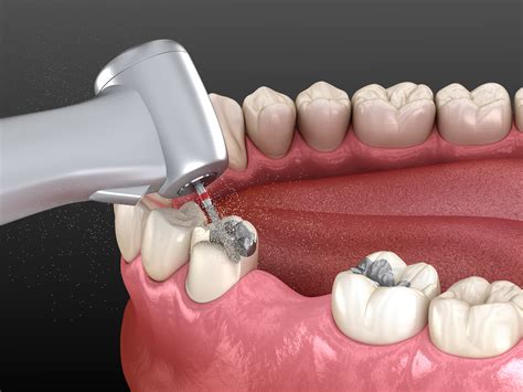 potential danger  mercury amalgam fillings dental health connections holistic dentistry