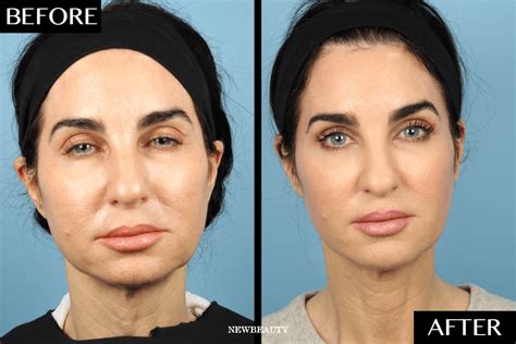 The Nonsurgical Procedure That Gave This 52 Year Old Woman The Look Of