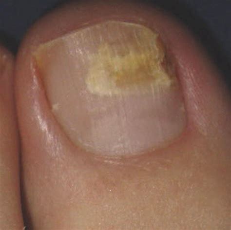 fungal nail infections  symptoms treatment fungal nail infections