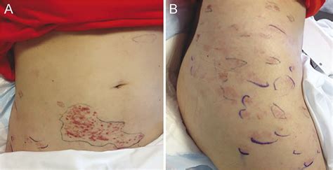 Disseminated Zoster With Paresis In A Multiple Sclerosis Patient