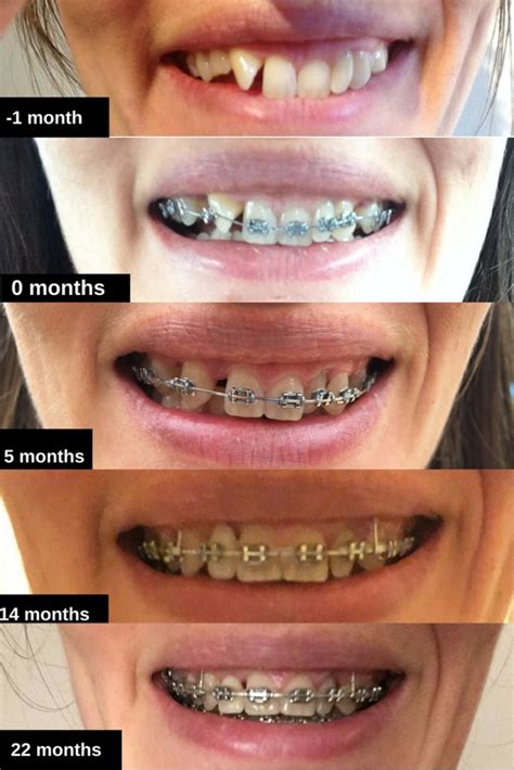 braces at 30 braces pinterest ortodoncia odontología and dientes
