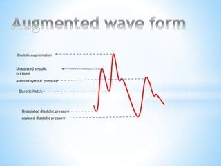 iabp wave forms