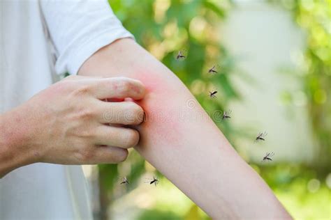 mensen jeuk en krabben op arm van allergie huiduitslag veroorzaakt door muggenbeet stock