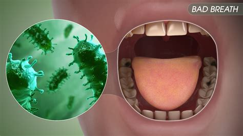 bad breath symptoms causes and treatment scientific animations