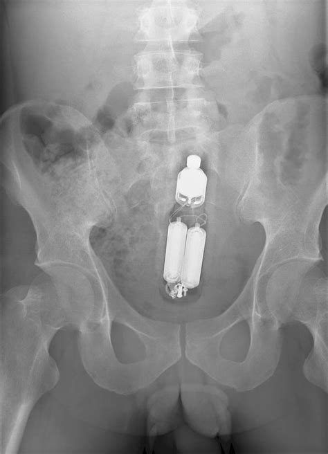 sex toy in man s rectum x ray photograph by du cane