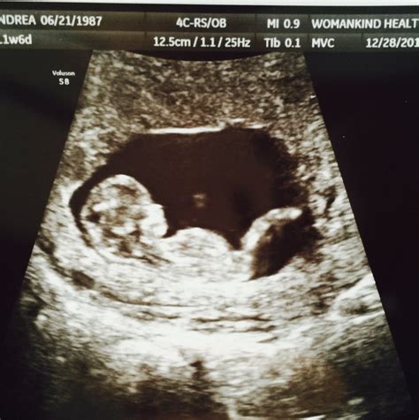 11 weeks pregnant ultrasound