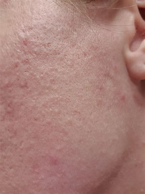 [skin Concerns] These Tiny Bumps Are All Over My Cheeks