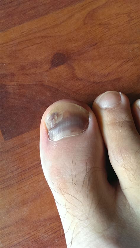 Black Toenail Hall Of Fame Ultramarathon News Podcasts