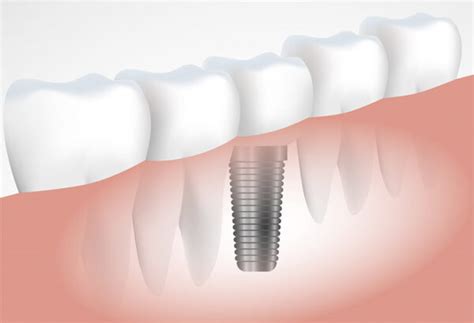 implantes dentários marcos hayashi odontologia digital