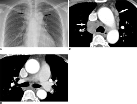 Imaging Findings For Mediastinal Lymphadenopathy Withou Open I