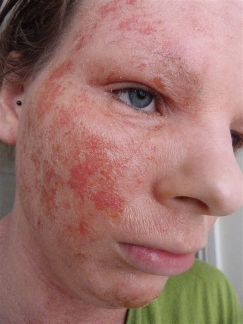 eczema topical steroid withdrawal insanity