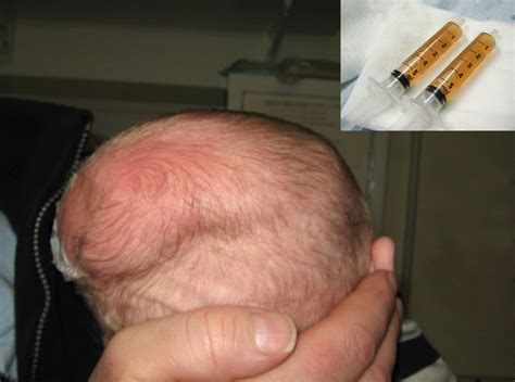 unusual swelling   infants head adc fetal neonatal edition