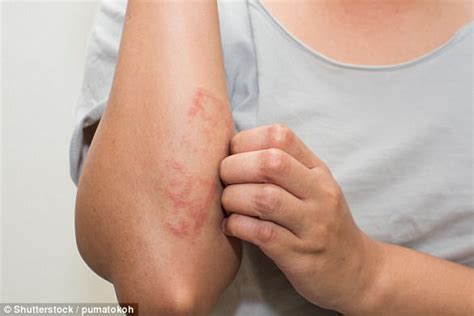 fda approves first drug for moderate and severe eczema daily mail online