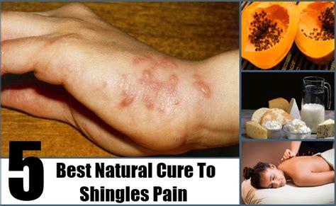 5 Best Natural Cure For Shingles Pain How To Cures Shingles Pain