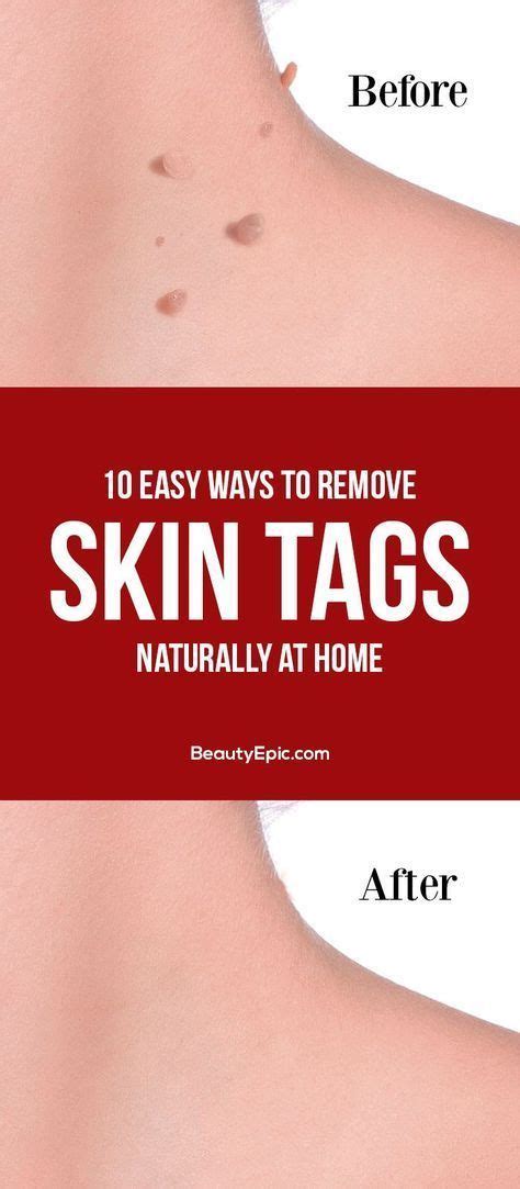 how to remove skin tags naturally at home remove skin tags naturally skin tag removal skin