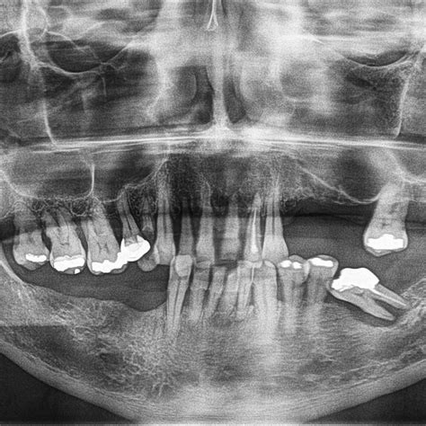 enfermedad periodontal generalizada dento metric radiologia dental