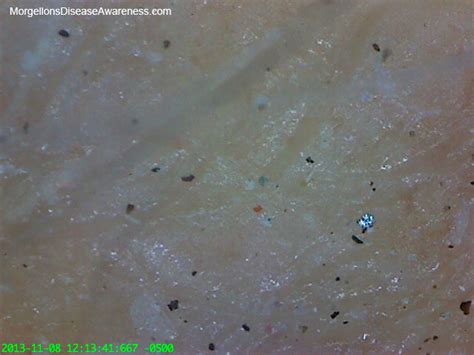 morgellons disease awareness morgellons disease physicians reference