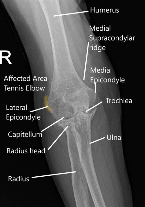 tennis elbow joint pain   management complete orthopedics