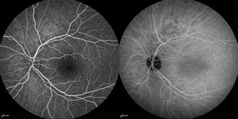 equipement de diagnostic oculaire angiographie retinienne numerique