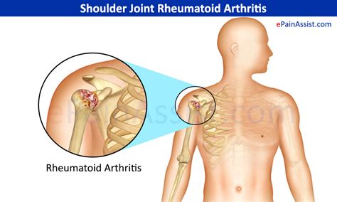 shoulder joint rheumatoid arthritis symptoms treatment conservative pt
