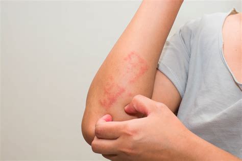 Eczema Q Dermatology