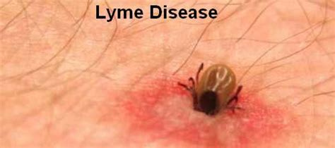 Lyme Disease Causes Symptoms Treatment And Prevention Health And