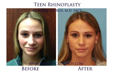 teen rhinoplasty nose job other xxx photos