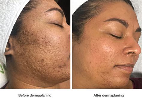 Dermaplaning Facial Is So Much More Than Shaving Your Face