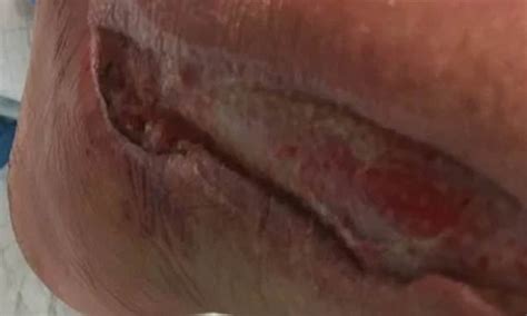 california woman ravaged by flesh eating bacteria losing