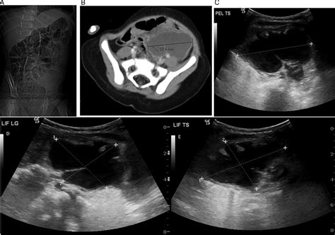 infected transverse colonic cystic duplication simulating pelvic