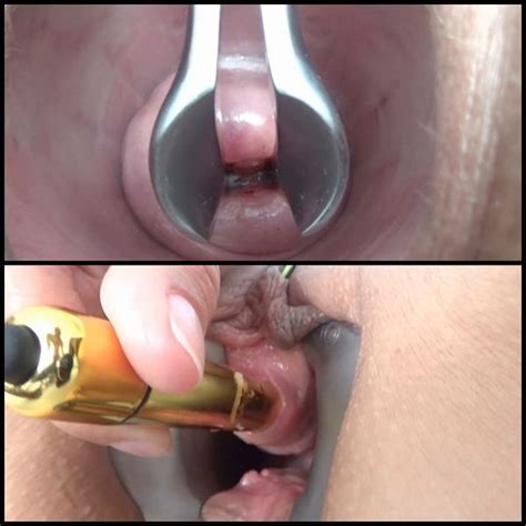 forumophilia porn forum extreme anal dilation and anal