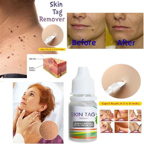 10ml body warts treatment cream skin tag remover foot corn removal plantar genital warts