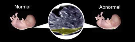 updated guide  ultrasound nt scan timing results cost