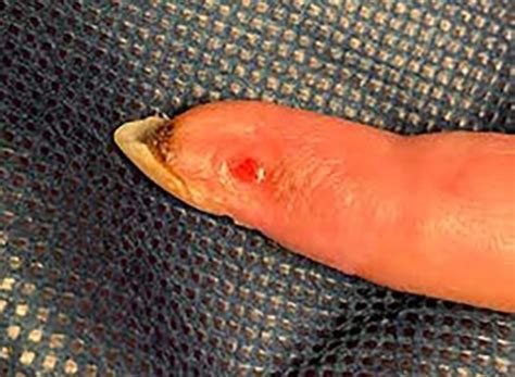 woman s finger turns black after she mistakenly injected smallpox virus