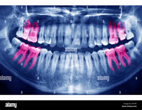 Foto Dental Fotografías E Imágenes De Alta Resolución Alamy