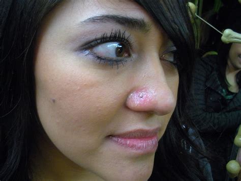 nose piercing infection bump fungal infection in nails