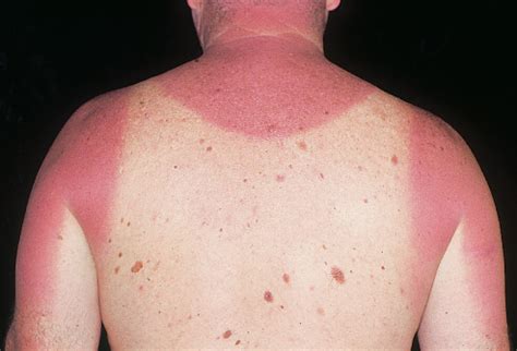 avoid sunburn    treat  sunburn