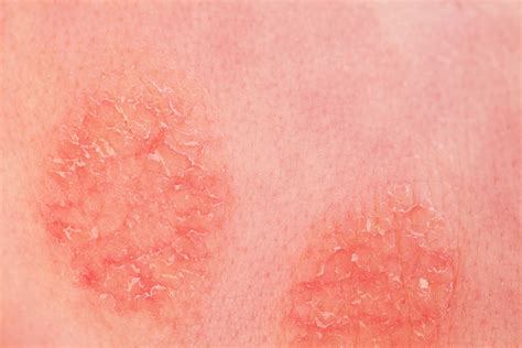 types  treatments nummular eczema eczema awareness monthly