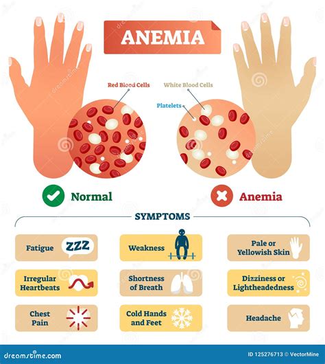 anemia cartoons illustrations vector stock images  pictures