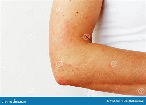 roeda pustlar och blasor pa huden av handen som tecken av photodermatitisen allergisk reaktion