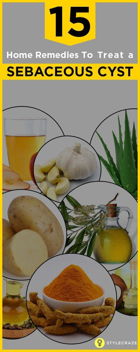 14 home remedies to treat sebaceous cysts home remedies remedies