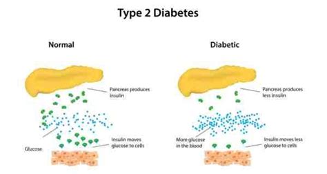 type 2 diabetes treatment type 2 diabetes symptoms