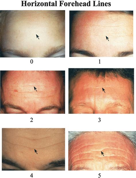 wrinkle assessment scale  horizontal forehead lines  scientific diagram facial