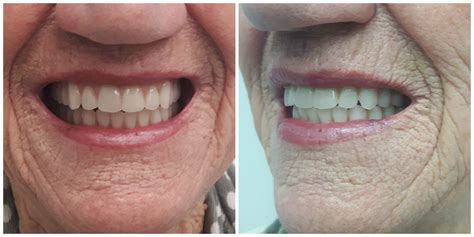 complete upper denture implant retained complete  denture kelowna denture clinic