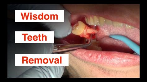 hurt    wisdom teeth removed