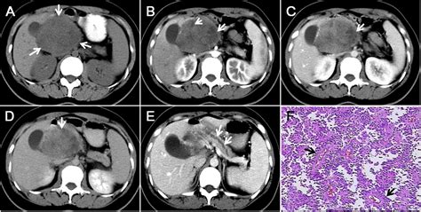 Solid Pseudopapillary Tumor Of The Pancreas Clinical Features And