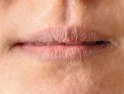 lip lickers eczema dermatitis medical secrets